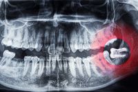 избелване на зъби - 62159 оферти