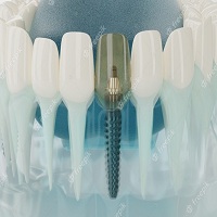 зъбни импланти - 13548 типа