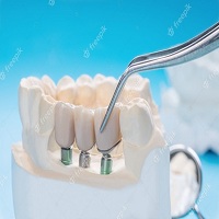 зъбни импланти - 75967 вида
