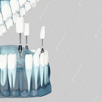 зъбни импланти - 54793 типа