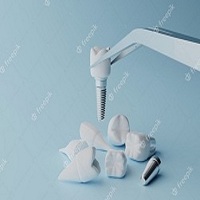 зъбни импланти - 4286 снимки