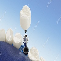 зъбни импланти - 99558 отстъпки