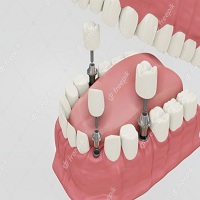 зъбни импланти - 42596 снимки