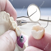 зъбни импланти - 96589 комбинации