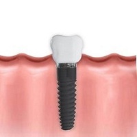 зъбни импланти - 92895 селекции