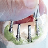 зъбни импланти - 87339 бестселъри