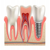 зъбни импланти - 69559 комбинации