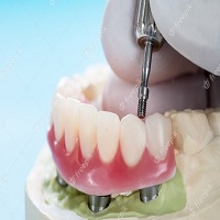 зъбни импланти - 30574 комбинации