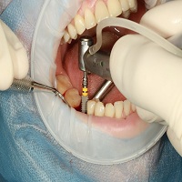 зъбни импланти - 82963 награди